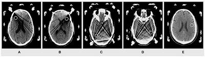 Comparison of Image Quality and Radiation Dose Between Single-Energy and Dual-Energy Images for the Brain With Stereotactic Frames on Dual-Energy Cerebral CT